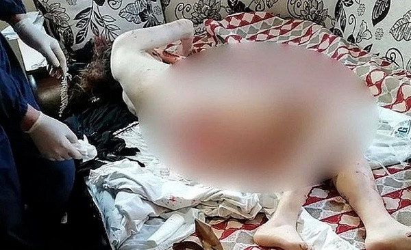 Thương tâm cô gái 20 tuổi nguy kịch vì bị chó hoang tấn công - Hình 3 Thuong tam co gai 20 tuoi nguy kich vi bi cho hoang tan cong-Hinh-3