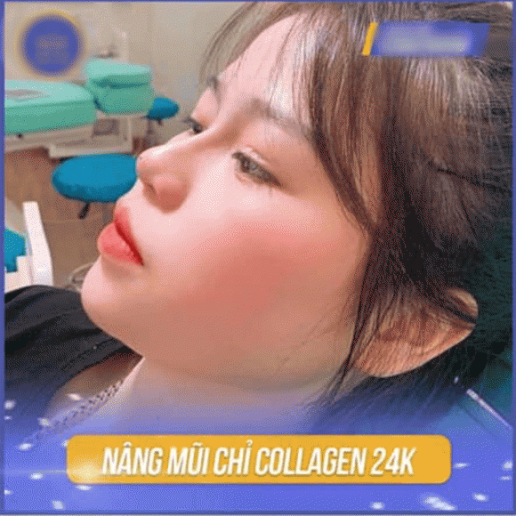 Xôn xao hình ảnh người yêu Quang Hải nâng mũi, sửa mặt - Hình 2 Xon xao hinh anh nguoi yeu Quang Hai nang mui, sua mat-Hinh-2