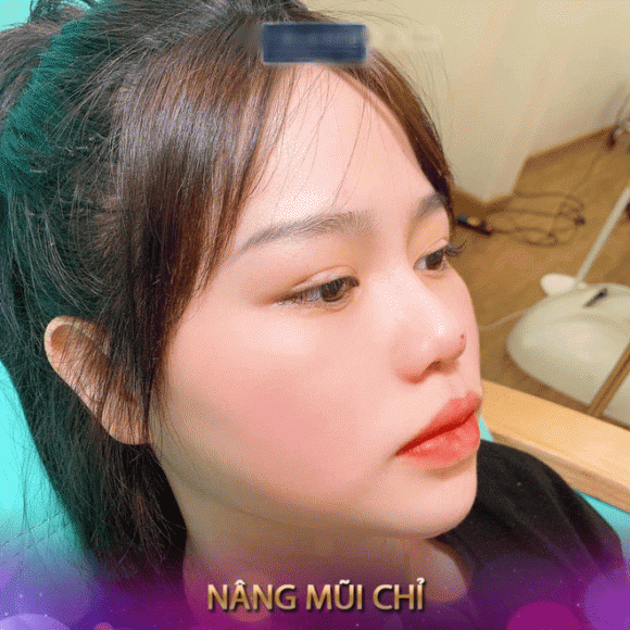 Xôn xao hình ảnh người yêu Quang Hải nâng mũi, sửa mặt Xon xao hinh anh nguoi yeu Quang Hai nang mui, sua mat