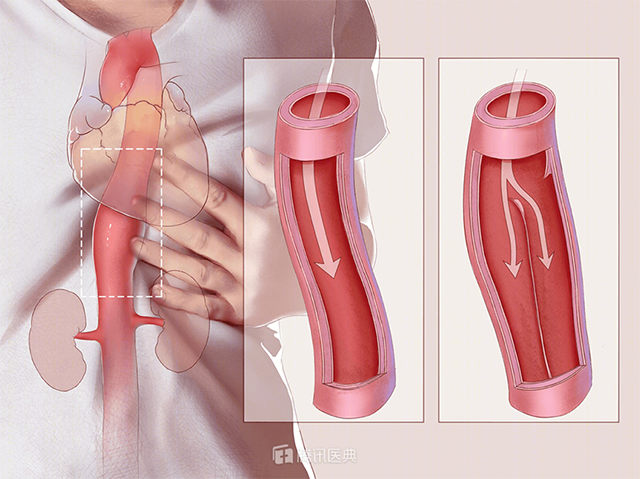 Thủ phạm là căn bệnh mang tên kẻ giết người lốc xoáy - Hình 2 Thu pham la can benh mang ten ke giet nguoi loc xoay-Hinh-2