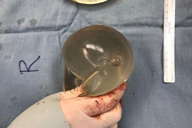 Thấy nóng trong ngực, cô gái mới phát hiện mình bị đạn bắn từ lúc nào Thay nong trong nguc, co gai moi phat hien minh bi dan ban tu luc nao