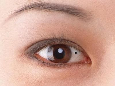 Người có nốt ruồi ở lòng trắng mắt thường tài vận kém và khó chung thủy Nguoi co not ruoi o long trang mat thuong tai van kem va kho chung thuy