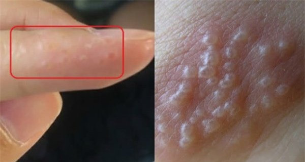 4 triệu chứng trên ngón tay cho thấy chất độc trong cơ thể đang bùng phát ảnh 1 4 triệu chứng trên ngón tay cho thấy chất độc trong cơ thể đang bùng phát ảnh 1