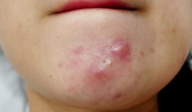 6 biểu hiện trên mặt cảnh báo chị em đang mắc bệnh phụ khoa - Hình 2 6 bieu hien tren mat canh bao chi em dang mac benh phu khoa-Hinh-2