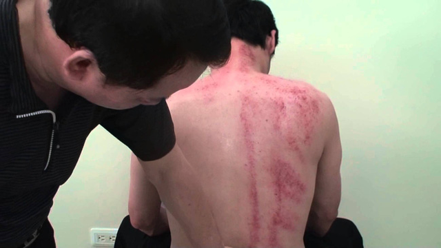 Chồng tôi đột ngột hôn mê sâu rồi qua đời sau khi cạo gió - Hình 2 Chong toi dot ngot hon me sau roi qua doi sau khi cao gio-Hinh-2