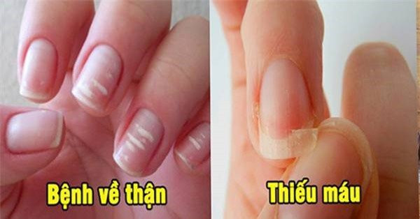 6 dấu hiệu ở móng tay cảnh báo bệnh nguy hiểm, đừng chủ quan - Hình 2 6 dau hieu o mong tay canh bao benh nguy hiem, dung chu quan-Hinh-2