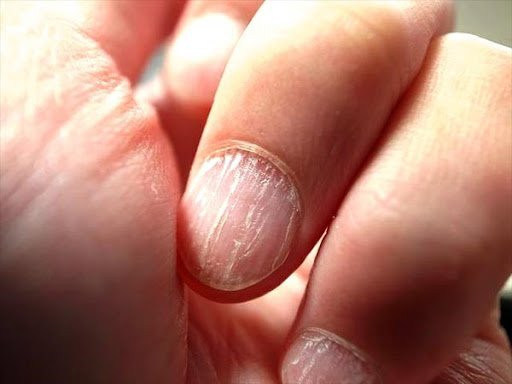 6 dấu hiệu ở móng tay cảnh báo bệnh nguy hiểm, đừng chủ quan 6 dau hieu o mong tay canh bao benh nguy hiem, dung chu quan