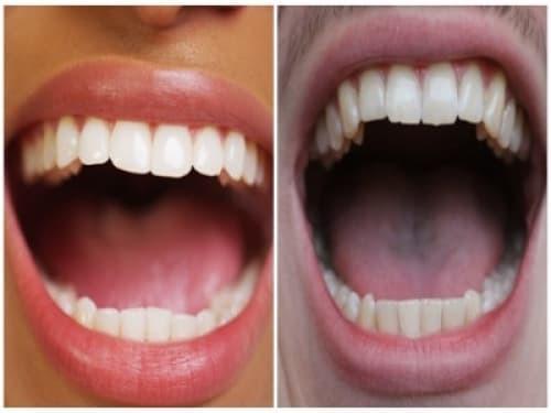 Làm thế nào để ngăn ngừa ung thư miệng trong cuộc sống hàng ngày Lam the nao de ngan ngua ung thu mieng trong cuoc song hang ngay