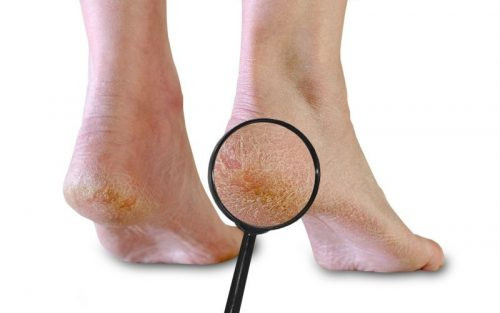 Cách trị nứt nẻ gót chân bằng loạt công thức đơn giản - Hình 2 Cach tri nut ne got chan bang loat cong thuc don gian-Hinh-2