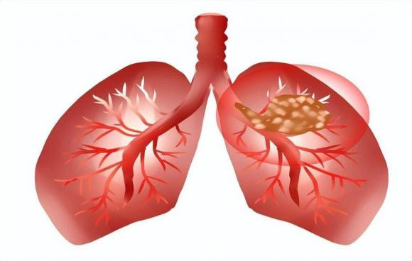 Làm thế nào để xua tan các nốt phổi được phát hiện? Lam the nao de xua tan cac not phoi duoc phat hien?