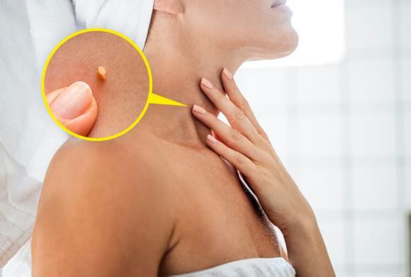Nốt ruồi đến từ đâu, tại sao việc phân biệt chúng lại quan trọng? - Hình 4 Not ruoi den tu dau, tai sao viec phan biet chung lai quan trong?-Hinh-4