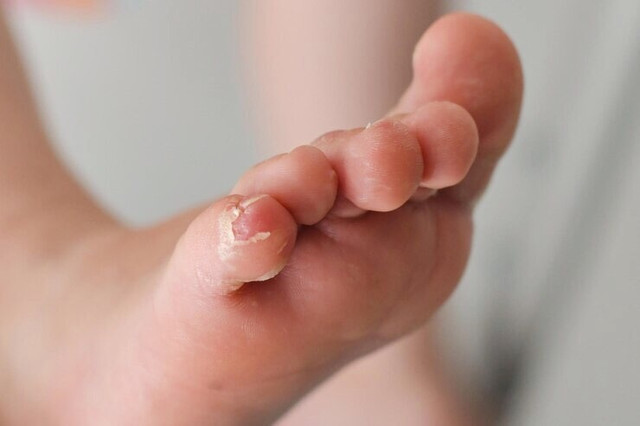 Dấu hiệu bệnh giang mai bẩm sinh ở trẻ Dau hieu benh giang mai bam sinh o tre