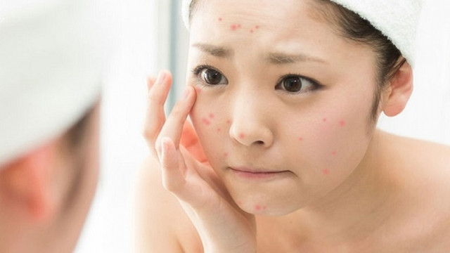 4 bí quyết vàng bạn nhất định phải biết để trị hết thâm mụn 4 bi quyet vang ban nhat dinh phai biet de tri het tham mun