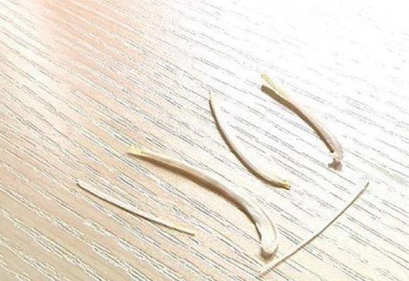 Xương cá mắc nghẹn cổ họng, nuốt cơm dấm là sai! - Hình 6 Xuong ca mac nghen co hong, nuot com dam la sai!-Hinh-6