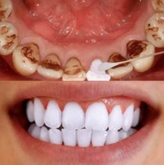 Bỏ 'thứ này' vào nước súc miệng, trả lại hàm răng trắng bóng Bo 'thu nay' vao nuoc suc mieng, tra lai ham rang trang bong