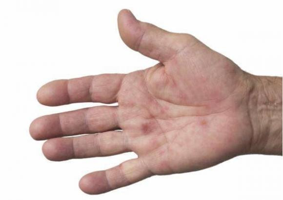 Gan không tốt sẽ xuất hiện 4 loại “dị tật” về da - Hình 4 Gan khong tot se xuat hien 4 loai “di tat” ve da-Hinh-4