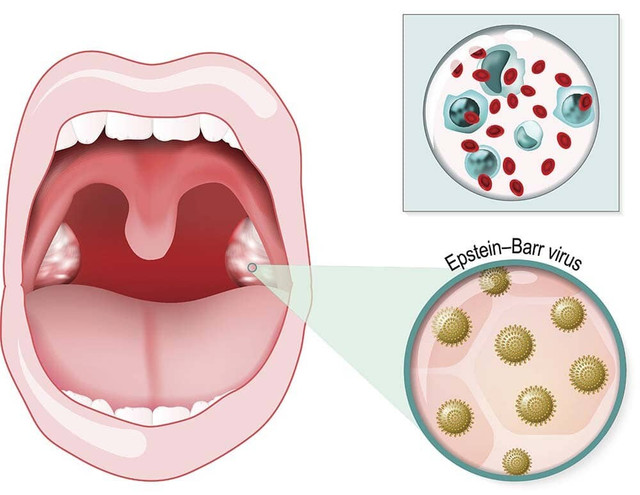 Một số bệnh do virus lây truyền qua nụ hôn Mot so benh do virus lay truyen qua nu hon