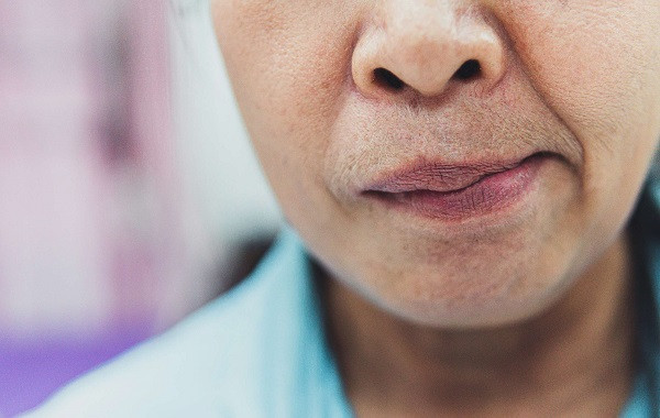 Liệt mặt, méo miệng sau khi ngủ phòng điều hòa, phòng tránh thế nào? Liet mat, meo mieng sau khi ngu phong dieu hoa, phong tranh the nao?