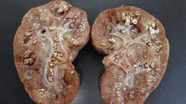 4 thói quen ăn uống khiến sỏi thận xuất hiện ngày càng nhiều 4 thoi quen an uong khien soi than xuat hien ngay cang nhieu