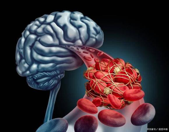 Người đàn ông 50 tuổi liệt nửa đêm vì nhồi máu não - Hình 2 Nguoi dan ong 50 tuoi liet nua dem vi nhoi mau nao-Hinh-2