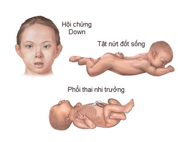 Trẻ mắc hội chứng Down. Các nhà khoa học khẳng định, trẻ mắc chứng Down có khả năng phát triển ung thư máu cao hơn từ 10-20 lần so với thông thường. Dù vậy, thực tế người ta chỉ ghi nhận một tỷ lệ rất nhỏ bệnh nhân ung thư máu được phát hiện nhóm đối tượng này.