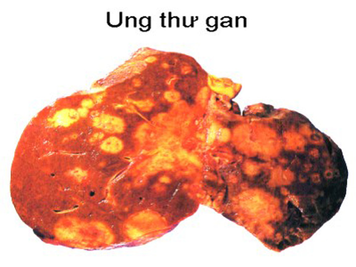 Gan có xu hướng phình to.