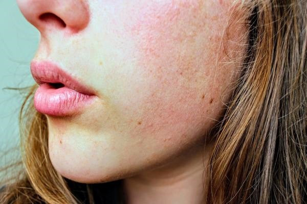 Các vấn đề về da: Đôi khi các vấn đề bên trong cơ thể lại biểu hiện ra bên ngoài. Tiền tiểu đường có thể gây ra các mảng sáng bóng, có vảy hoặc các mảng tối trên da do nồng độ insulin trong máu tăng lên. Tiền tiểu đường cũng ảnh hưởng đến lưu thông máu, có thể gây ngứa ở tứ chi, đặc biệt là chân.