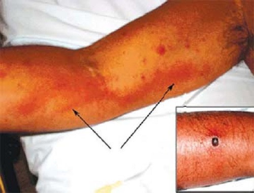 Ban thường xuất hiện đầu tiên ở ngực, bụng sau đó lan ra toàn thân và các chi, rất hiếm thấy ban mọc ở mặt, gan bàn chân, bàn tay. Đặc điểm của sốt thường là sau một cơn rét run và kéo dài từ 2 - 3 tuần lễ. Một đặc điểm cần lưu ý là nơi bị mò đỏ đốt thường tạo thành vết loét. Vết loét này thường không ngứa, vị trí của vết đốt hay ở hõm nách, cánh tay, bắp chân hoặc có thể có ở thân mình, đùi, bìu…