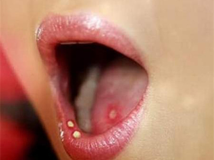 Loét miệng. Vết loét có dấu hiệu giống như vết cắn và chúng chỉ xuất hiện một vài ngày. Không quá nghiêm trọng song loét miệng có thể báo hiệu những vấn đề sức khỏe nghiêm trọng khác như giang mai, ung thư môi hoặc các bệnh tự miễn dịch.