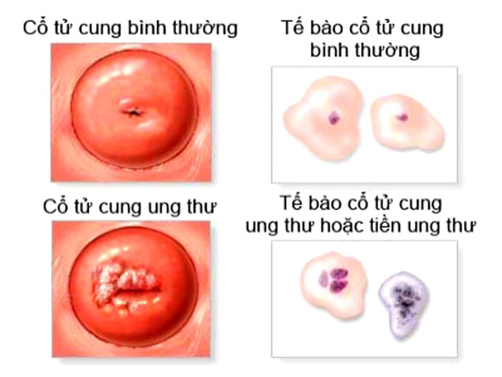 Tiến hành kiểm tra xem có xuất hiện khối u nào hay không. Những khối u này sờ vào đôi khi không mang lại cảm giác đau đớn, xung quanh được bảo vệ bởi lớp màng cứng.