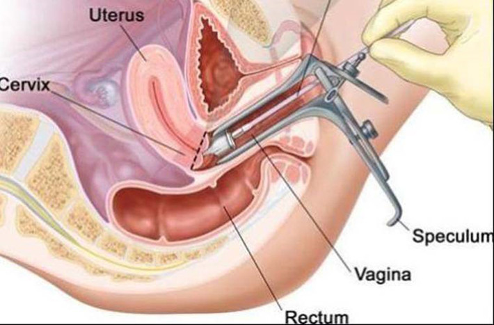 Lúc này, dùng gương quan sát thật kỹ khu vực bên trong. Chú ý đến màu sắc của cổ tử cung. Cổ tử cung khỏe mạnh sẽ trơn ướt, hơi hồng trong khi cổ tử cung của phụ nữ mang thai sẽ có màu hơi xanh.