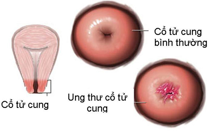 Lúc này, chú ý quan sát dịch cổ tử cung. Bình thường, dịch cổ tử cung trơn, màu trắng nhạt hơi dính. Nếu thấy dịch có màu giống như mủ, dịch có lẫn máu, màu nước gạo hay loãng như nước… cần lưu ý. Đặc biệt, nếu dịch lẫn máu, bạn nên cảnh giác nguy cơ u cổ tử cung.