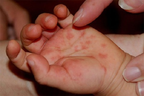 Tay chân miệng: Ở Việt Nam tích lũy từ đầu năm 2014 đến nay cả nước đã ghi nhận 18.659 trường hợp mắc tại hầu hết các tỉnh trên cả nước, ghi nhận 02 trường hợp tử vong tại Long An và Bà Rịa - Vũng Tàu. Mặc dù so với cùng kỳ năm trước số lượng bệnh nhân có giảm, tuy nhiên tại một số địa phương tỷ lệ mắc bệnh tay chân miệng vẫn cao, nhất là khu vực miền Nam.