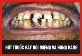 1. Hút thuốc lá gây hôi miệng và hỏng răng