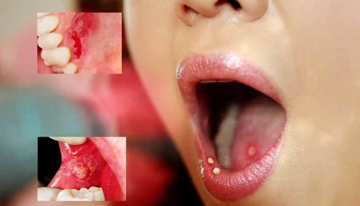 Ước tính khoảng 48% khả năng sống sót sau năm năm. Phát hiện dấu hiệu bệnh sớm có ý nghĩa quyết định đến hiệu quả điều trị.