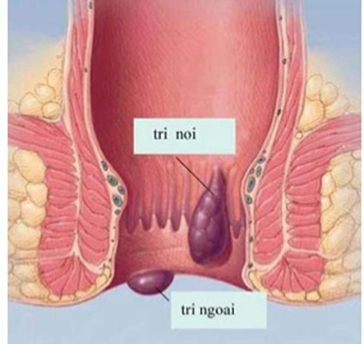 Ngoài ra, bệnh nhân còn bị ngứa hoặc dị ứng ở hậu môn. Triệu chứng này bắt nguồn từ việc búi trĩ sa ra ngoài, tiết dịch gây viêm da quanh hậu môn, làm cho bệnh nhân cảm giác lúc nào cũng ướt át và ngứa ngáy.