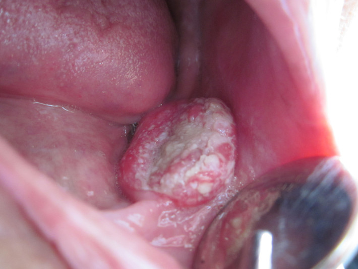 Với các khối u ác tính, Một khi bệnh có dấu hiệu di căn thì khả năng sống sót giảm xuống còn 50%. Điều này khẳng định tầm quan trọng của việc phát hiện bệnh sớm, nâng cao khả năng điều trị.