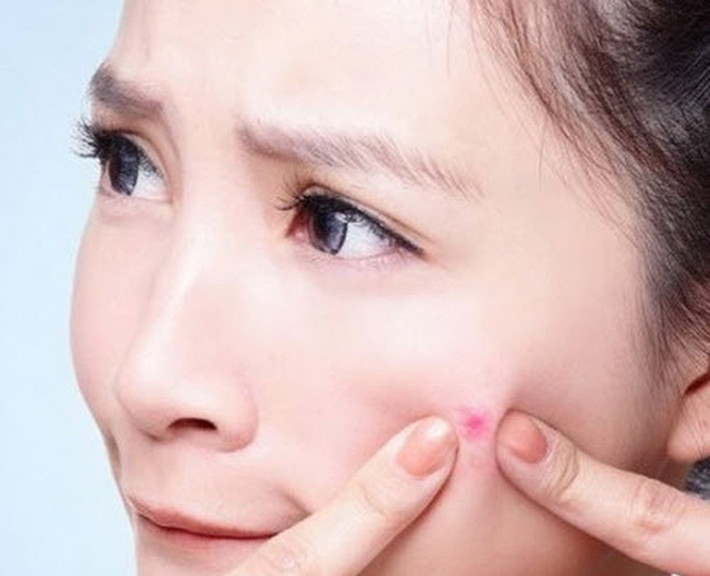 Việc cố gắng dùng tay để bóp, nặn mụn khiến phần da xung quanh dễ tấy đỏ và đau rát. Trong khi đó, không cần mất sức, chị em chỉ cần lấy chiếc kim nhỏ để đâm xuyên nốt mụn khó chịu.