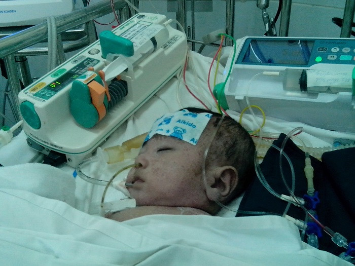 Một bệnh nhi biến chứng nặng đang được điều trị tích cực.