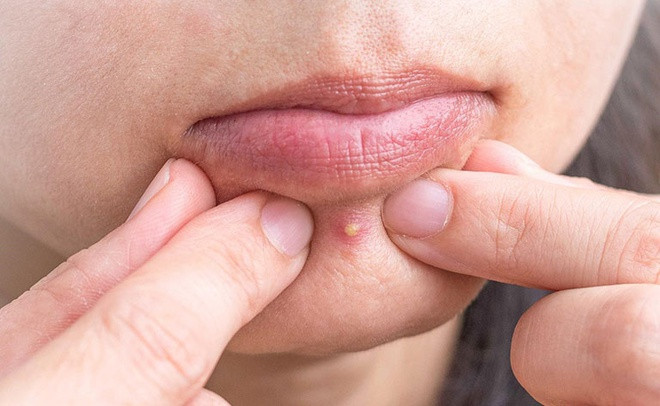 Cằm:Nổi mụn ở cằm là do mất cân bằng nội tiết tố. Bạn nên xây dựng thói quen ngủ đủ giấc, đều đặn, chế độ ăn uống lành mạnh. Ngoài ra, bạn có thể bổ sung trà bạc hà, omega-3 để giảm mụn ở cằm.