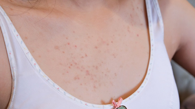 Mụn ở ngực:Nguyên nhân của tình trạng này có thể là thay đổi nội tiết tố, ăn nhiều thực phẩm ngọt, mất nước khi tập thể thao, dị ứng mỹ phẩm hoặc kích ứng da. Do vậy, bạn có thể khắc phục bằng cách thay đổi lối sống, chọn trang phục rộng, thoải mái, giảm đồ ngọt và uống nhiều nước.