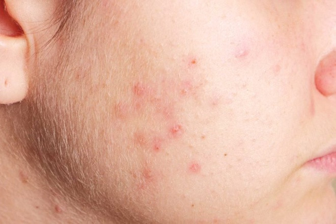 Má: Mụn gần đỉnh má liên quan vấn đề về hệ hô hấp. Trong khi đó, nếu bạn nổi mụn ở má dưới, cơ thể đang cảnh báo bạn vệ sinh răng miệng kém, nhiều vi khuẩn trong khoang miệng. TS Raj khuyên bạn nên làm sạch không khí trong nhà, cọ rửa và vệ sinh các vật dụng thường xuyên tiếp xúc má như điện thoại, cọ trang điểm, gối…