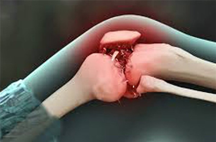 Xuất hiện khối u. Khi tế bào ung thư phát triển với lượng lớn, chúng dễ hình thành nên khối u bất thường. Khối u này có thể phát hiện bằng cách chạm tay vào. Tuy nhiên, nhiều trường hợp khối u nằm sâu trong các mô thịt nên rất khó để phát hiện. Đặc biệt, nếu khối u nằm ở trên hoặc gần khu vực khớp, việc vận động bình thường dễ dàng bị ảnh hưởng. Trong khi khối u ung thư nằm ở xương sống, nó sẽ tạo sức ép lên các dây chằng trong xương sống, làm các chi yếu đi, tê liệt hoặc đau nhói.