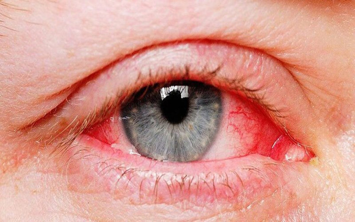 Mắt: Virus corona có thể làm đỏ mắt, gây đau mắt đỏ hoặc viêm kết mạc ở một số bệnh nhân.