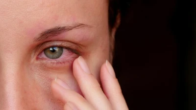 Dịch đau mắt đỏ lây nhanh trong trường: Phòng bệnh thế nào?
