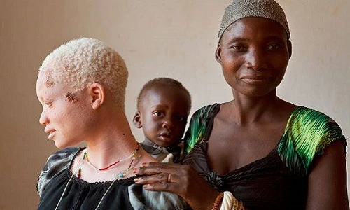 Khám phá gây đau lòng về người bạch tạng ở Tanzania