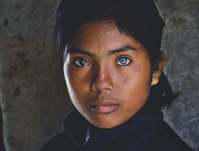 Những đôi mắt dị thường hiếm gặp nhất trên thế giới