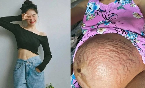 Đặng Thu Thảo bầu đôi bụng rạn chi chít, loạt sao chung cảnh ngộ