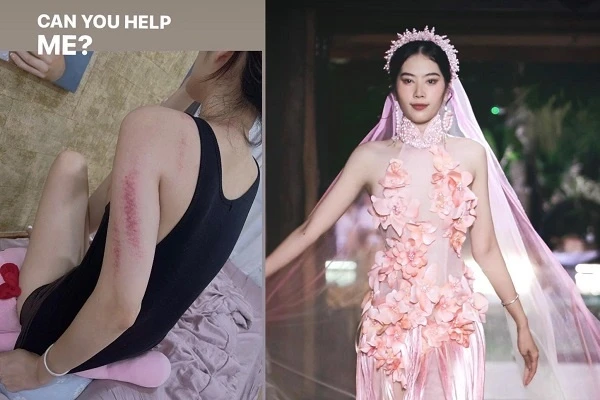Nam Em lộ vết bầm tím trên cơ thể, oán trách ai đó