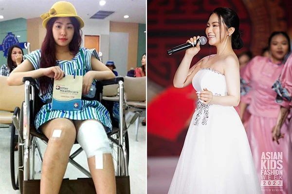 Từng bị tai nạn sân khấu bỏng nặng, Lương Bích Hữu giờ thế nào?